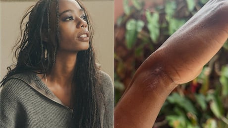 Modelo que sumiu em bairro nobre de SP mostra machucados no corpo em novo desabafo